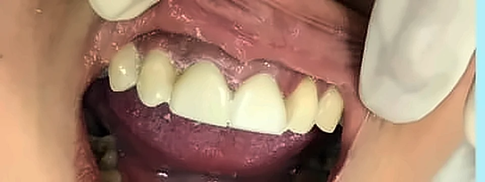 Después: dientes anteriores completos