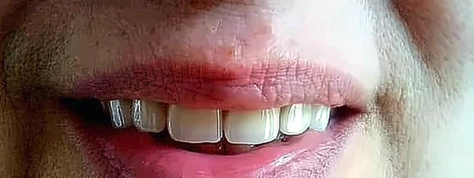 Después: dientes anteriores restaurados