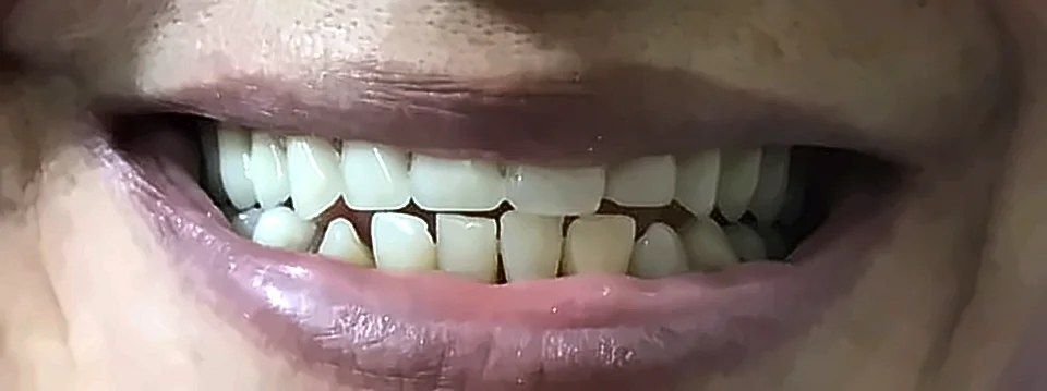 Después: sonrisa completa con prótesis superior