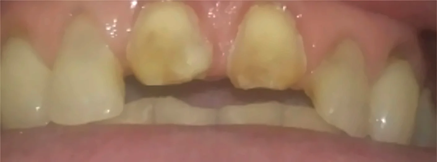 Antes: dientes anteriores dañados y con manchas