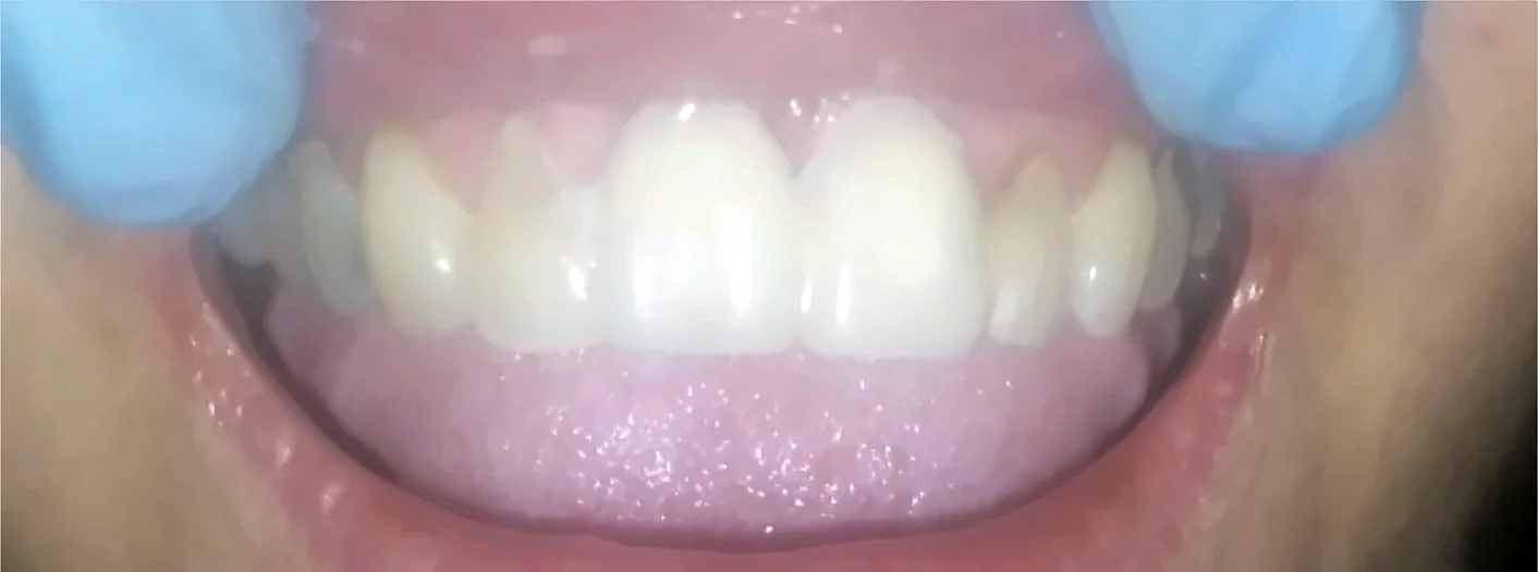 Después: dientes anteriores reconstruidos