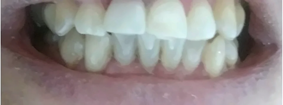Después: dientes más claros y parejos
