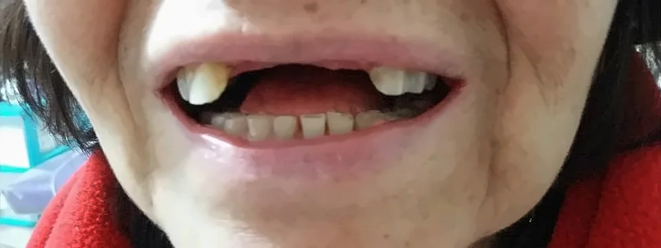 Antes: sonrisa con varios dientes faltantes
