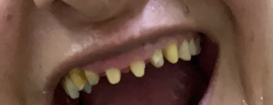 Antes: dientes superiores desgastados y faltantes