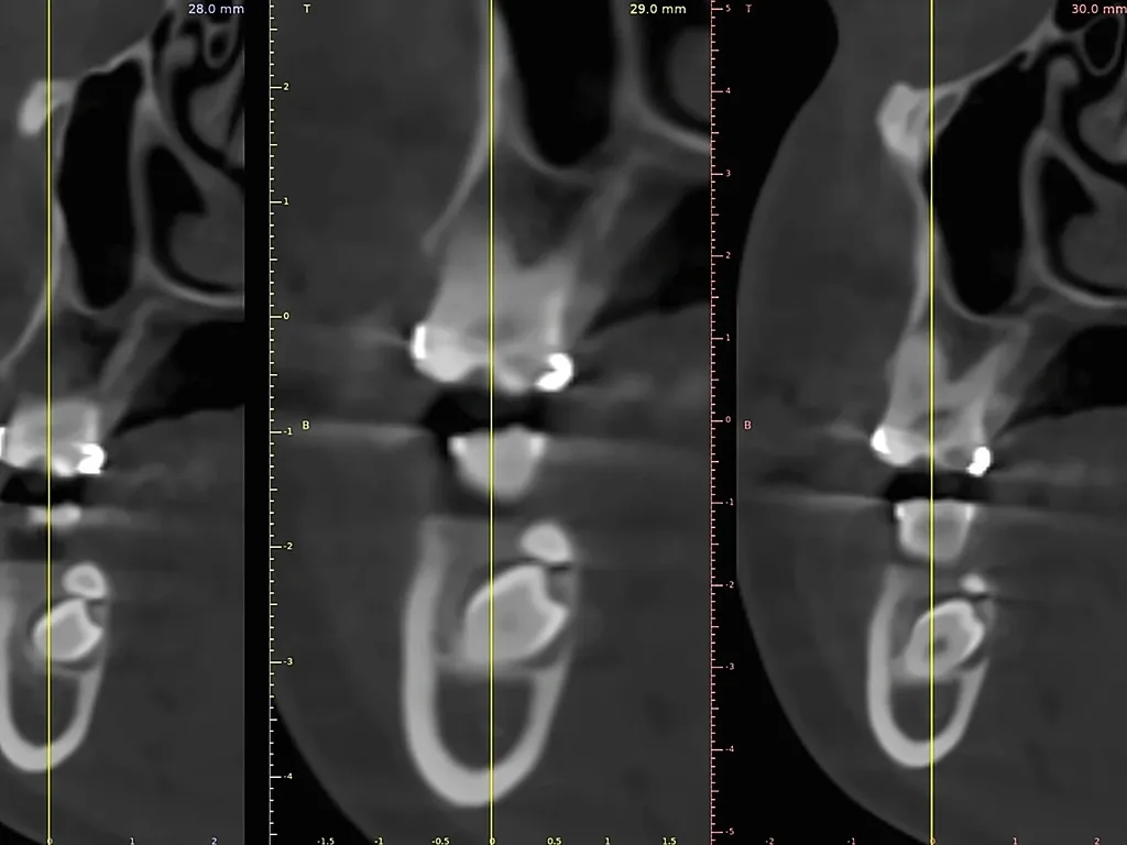 Cortes de tomografía con medidas para planear el tratamiento