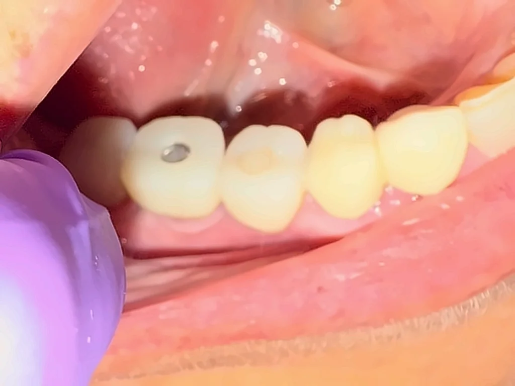 Coronas colocadas sobre implantes en la parte inferior de la boca